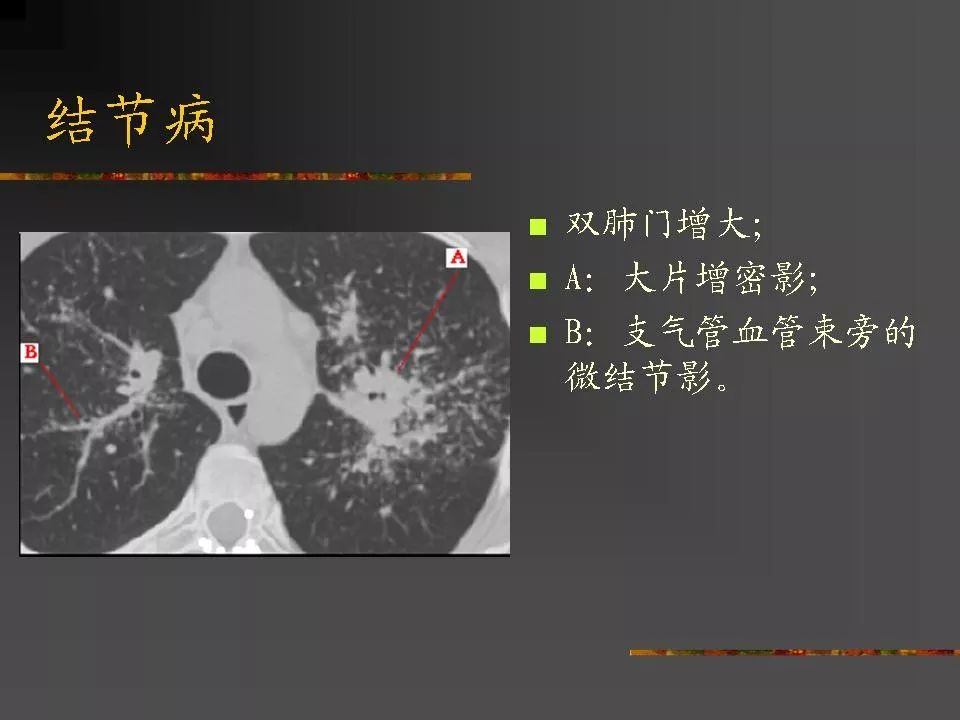间质性肺疾病及其影像诊断