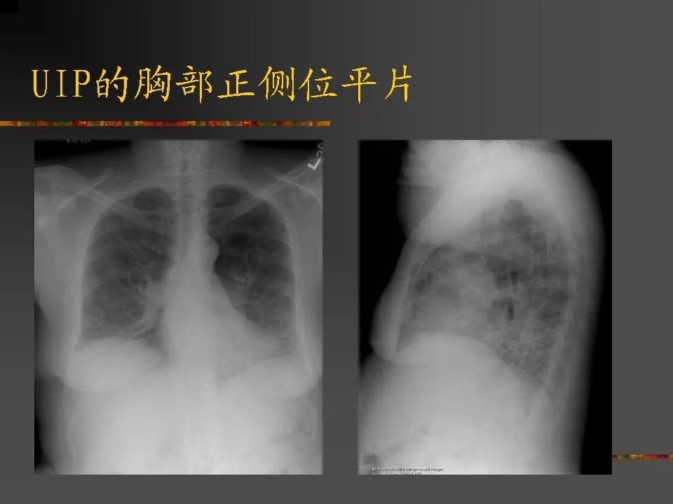 间质性肺疾病及其影像诊断