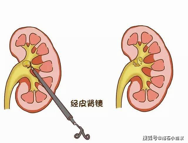 肾结石的主流治疗方式都在这!