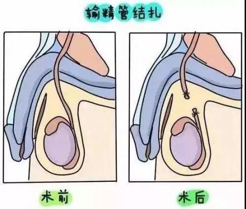 不想再生育,男性女性谁去结扎?答案