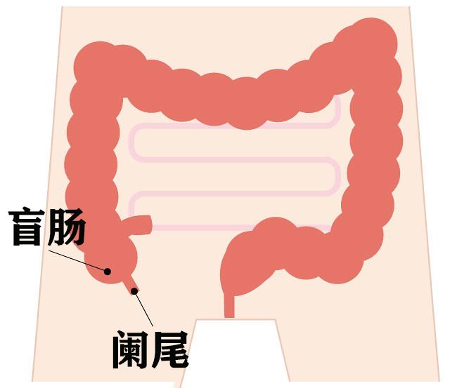 阑尾炎常被称为"盲肠炎",但阑尾事实上是盲肠起端后侧,位于右下腹的