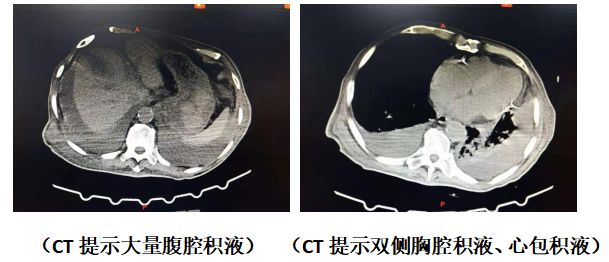 因低血糖致昏睡时间较长,入院时心电图提示房颤,ct提示大量腹腔积液