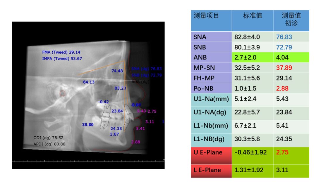 病例分享 l orthguide奥世美数字正畸导航系统