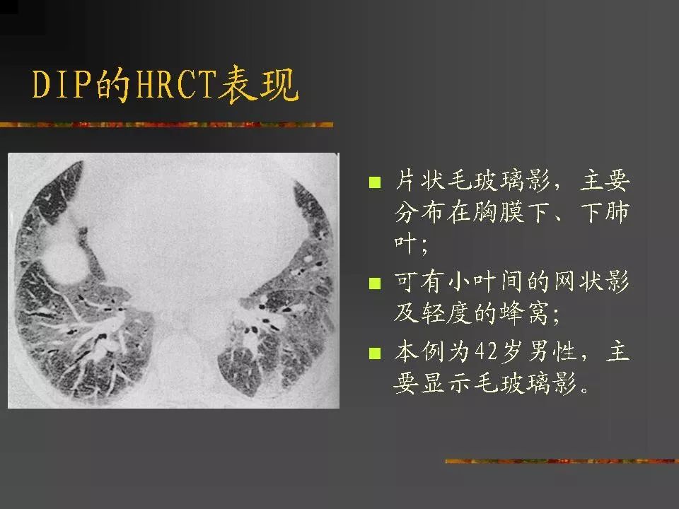 间质性肺疾病及其影像诊断