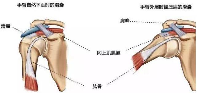 肩峰撞击综合症怎么办