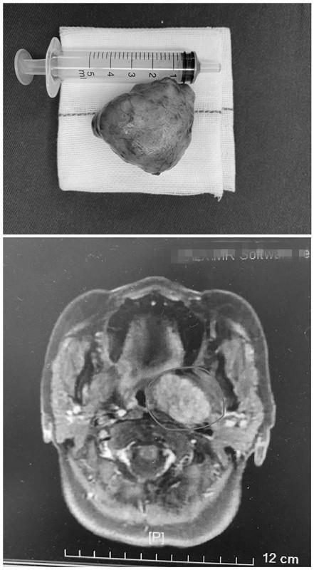  【医生手记】鸡蛋大小的肿瘤长在口腔里，为什么患者没症状？
