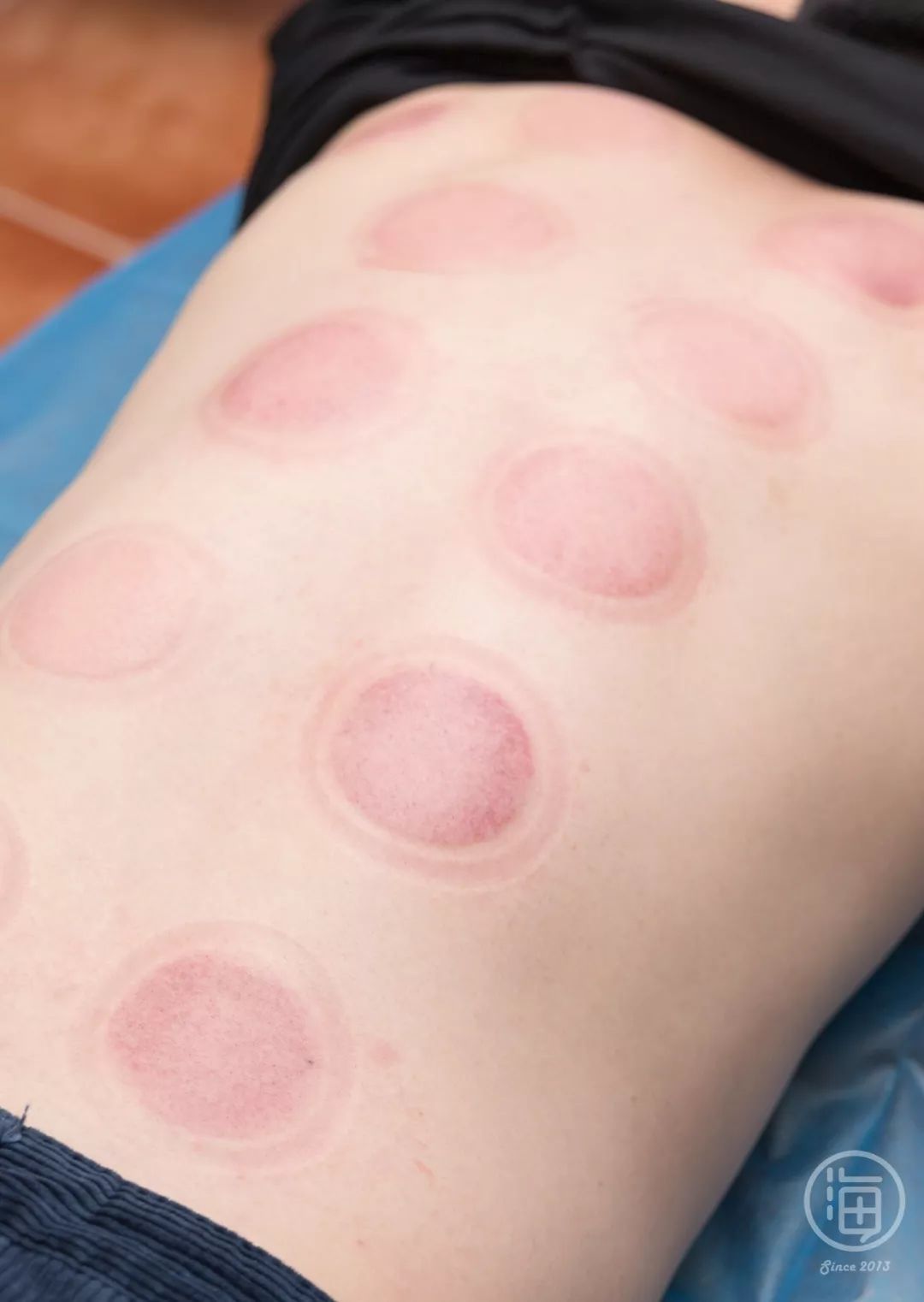 拔罐为什么只有一个部位有泡 94c7d8adc6be4da6933c1be585fdfecf.jpeg