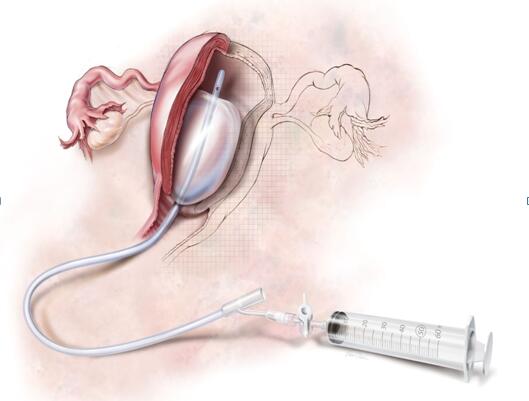 子宫球囊填塞术在防止产妇死亡出血方面几乎有86%的效果