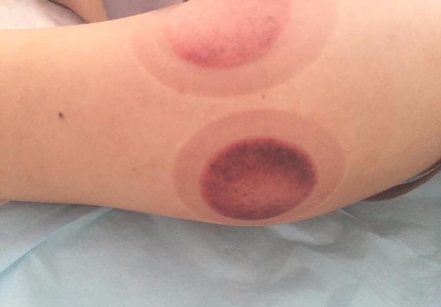 拔罐为什么只拔后背 abd22e17a1db4c3a83c3fff7e3df20b4.jpeg