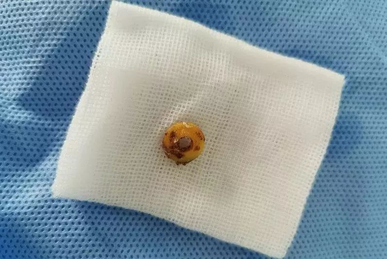 医生根据耳镜下看到的图像,找到右耳外耳道深处有一个深黄的圆形异物