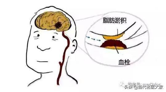 脑梗塞是什么系统 fdbb996d40d74b8488b5890a49d49597.jpeg