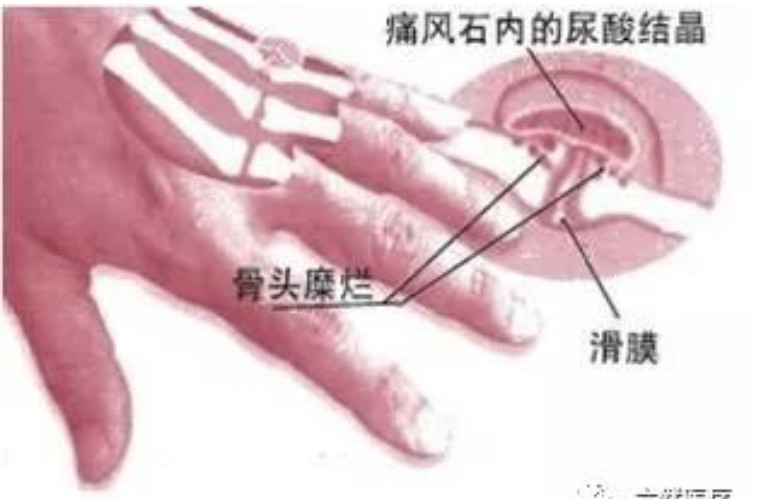 痛风石是化脓淤积一文揭开痛风石鲜为人知的一面震惊