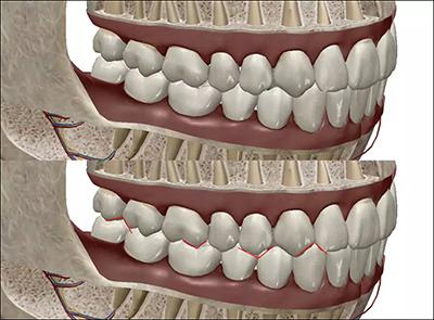 两个明显的特点:一牙对两牙,牙尖对牙窝.称"牙尖交错牙合".