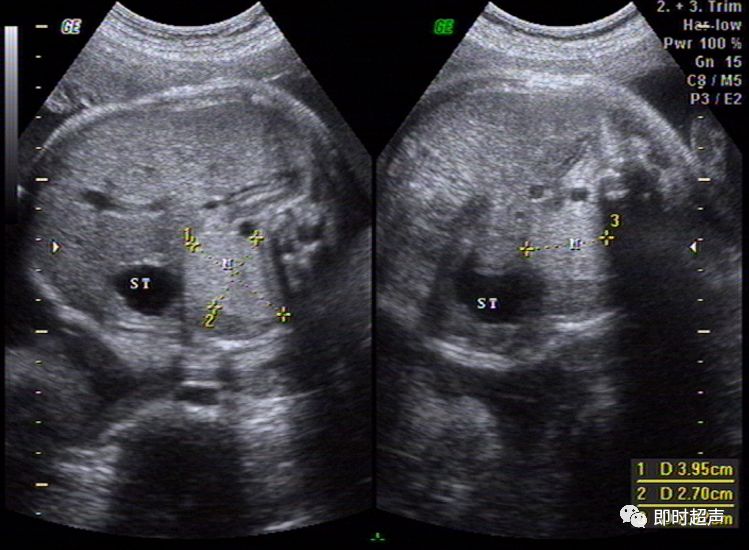 超详细图文胎儿中晚孕超声常用切面及胎儿常见异常畸形