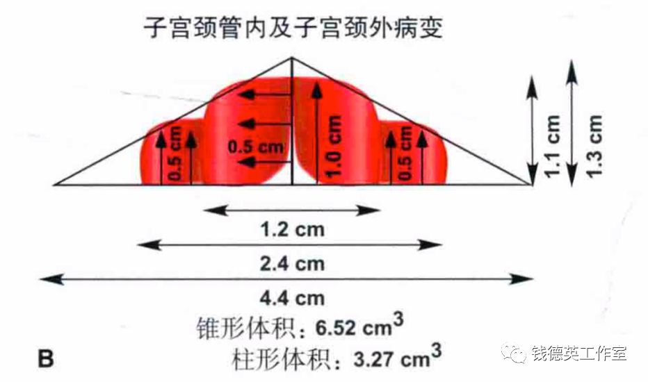 钱医生出诊记事如何确定leep的切除长度