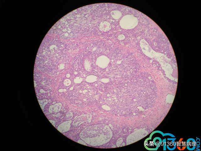 cm,囊实性,实性区淡黄质软cd10cdx2napsina阴 董筱微 类似输卵管癌的