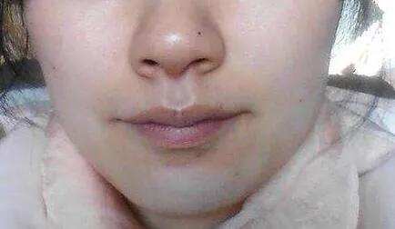 色素沉着怎么解决 7db67a25b29b47faa8e7b19326a932fa.jpeg