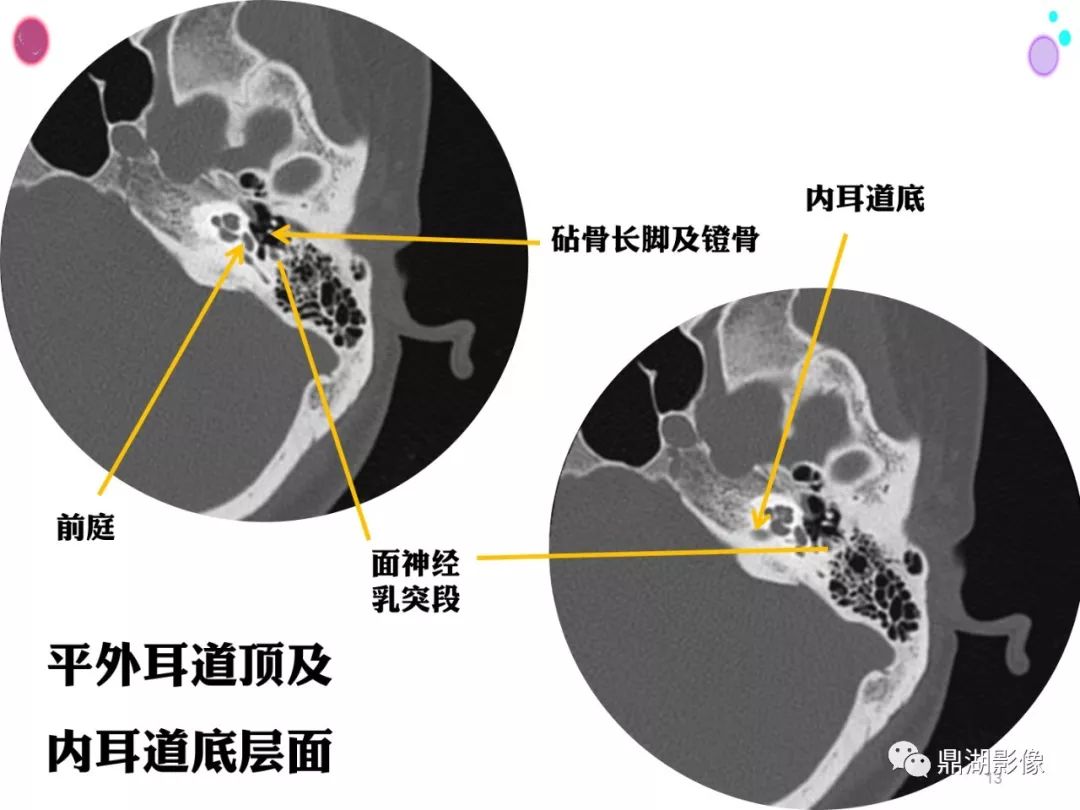 颞骨断层解剖及ct三维重建