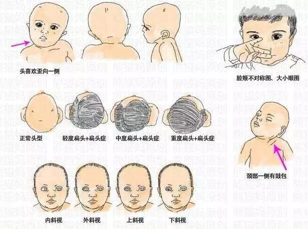 使头向该侧偏斜,是临床常见的类型; 2,骨性斜颈:由于颈椎骨骺畸形所致