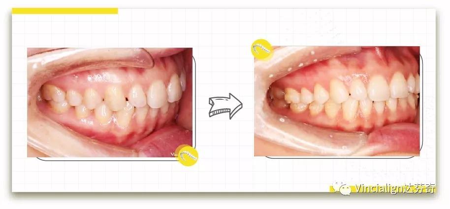 来看看这些整牙前后的对比图!_牙齿