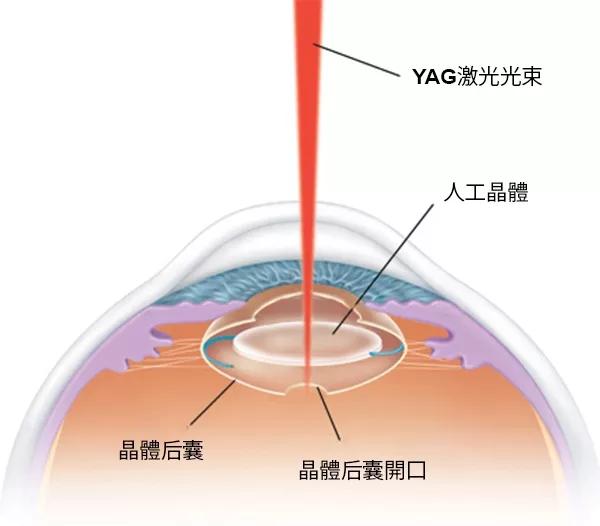 由医生检查眼底(视网膜和玻璃体),确定眼底情况合适后进行白内障手术