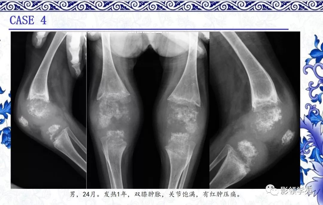 经典8种膝关节常见关节病的x线诊断