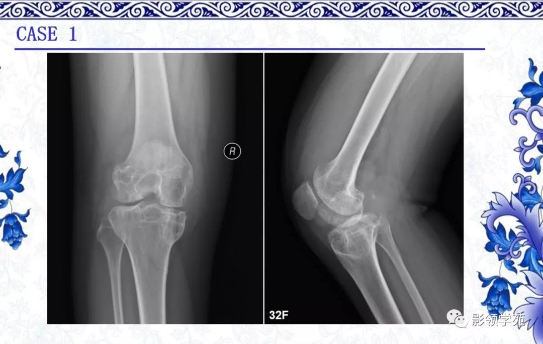 【经典】8种膝关节常见关节病的x线诊断