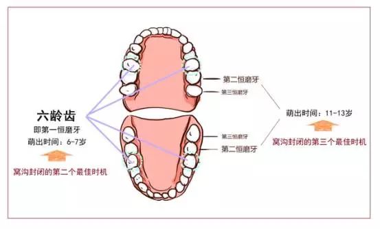 『冯欣源自然养育之家』周三窝沟封闭最佳年龄是几岁？妈妈们可千万别错过