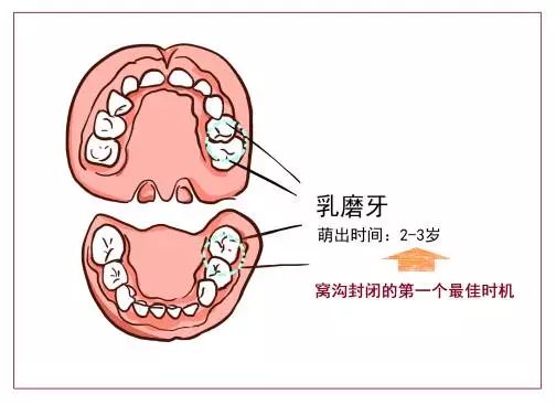 『冯欣源自然养育之家』周三窝沟封闭最佳年龄是几岁？妈妈们可千万别错过