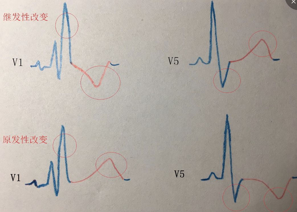 这4 张心电图,你看的对吗?(附答案)| 心电视频第 7 期