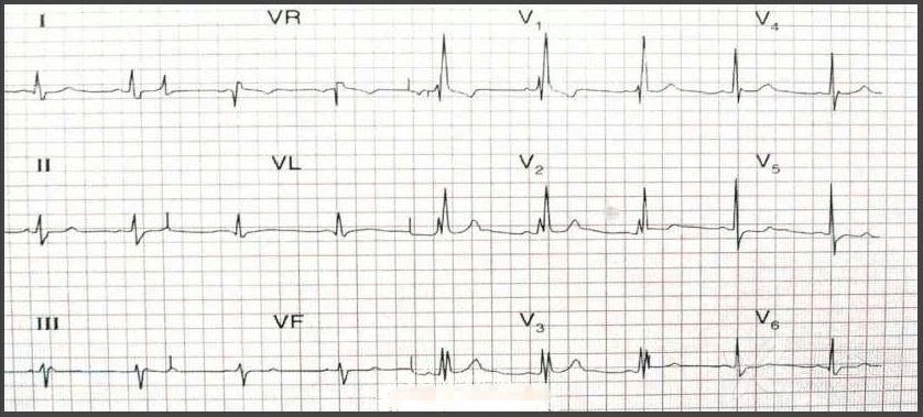 这 4 张心电图，你看的对吗？（附答案）| 心电视频第 7 期|