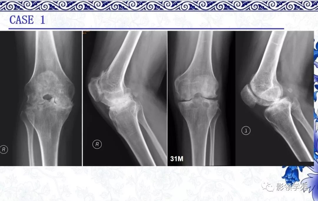 经典8种膝关节常见关节病的x线诊断