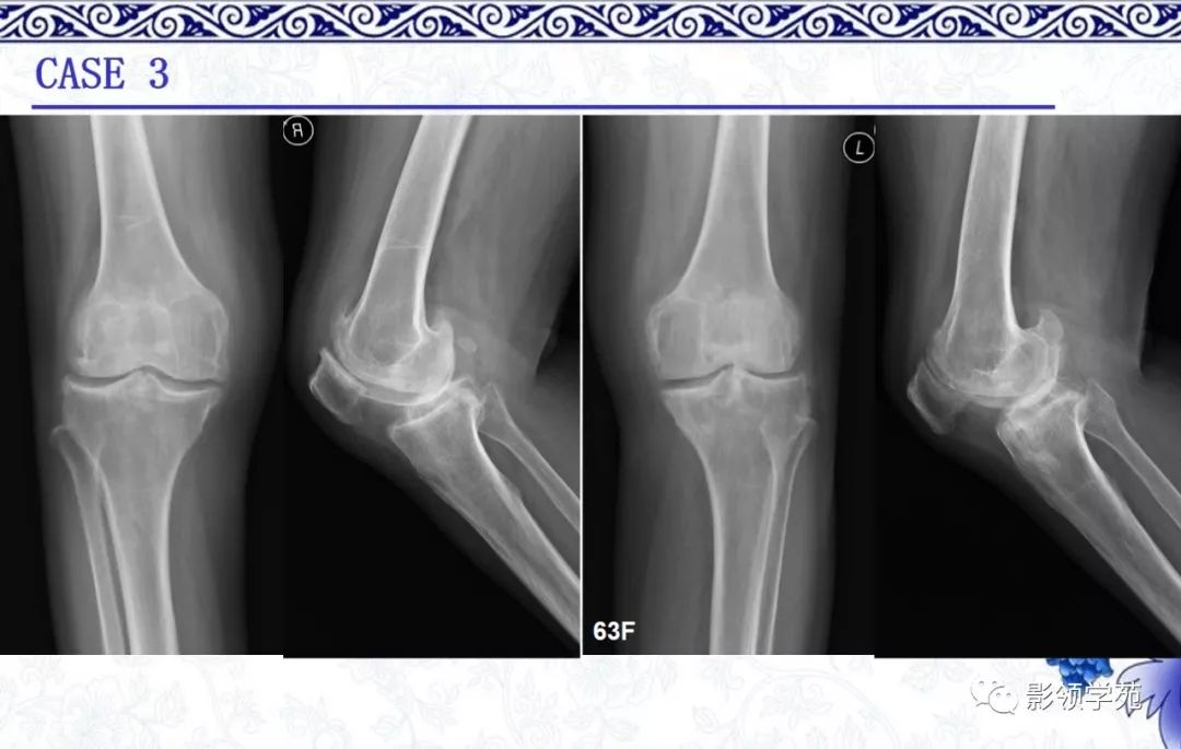 经典8种膝关节常见关节病的x线诊断