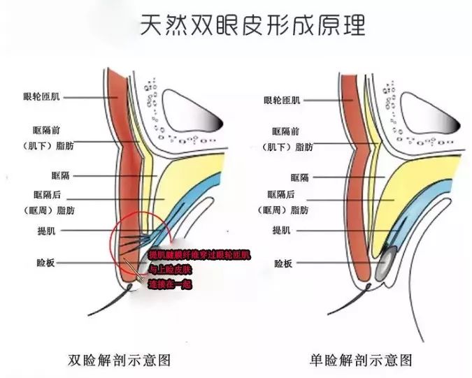 双眼皮一宽一窄怎么办