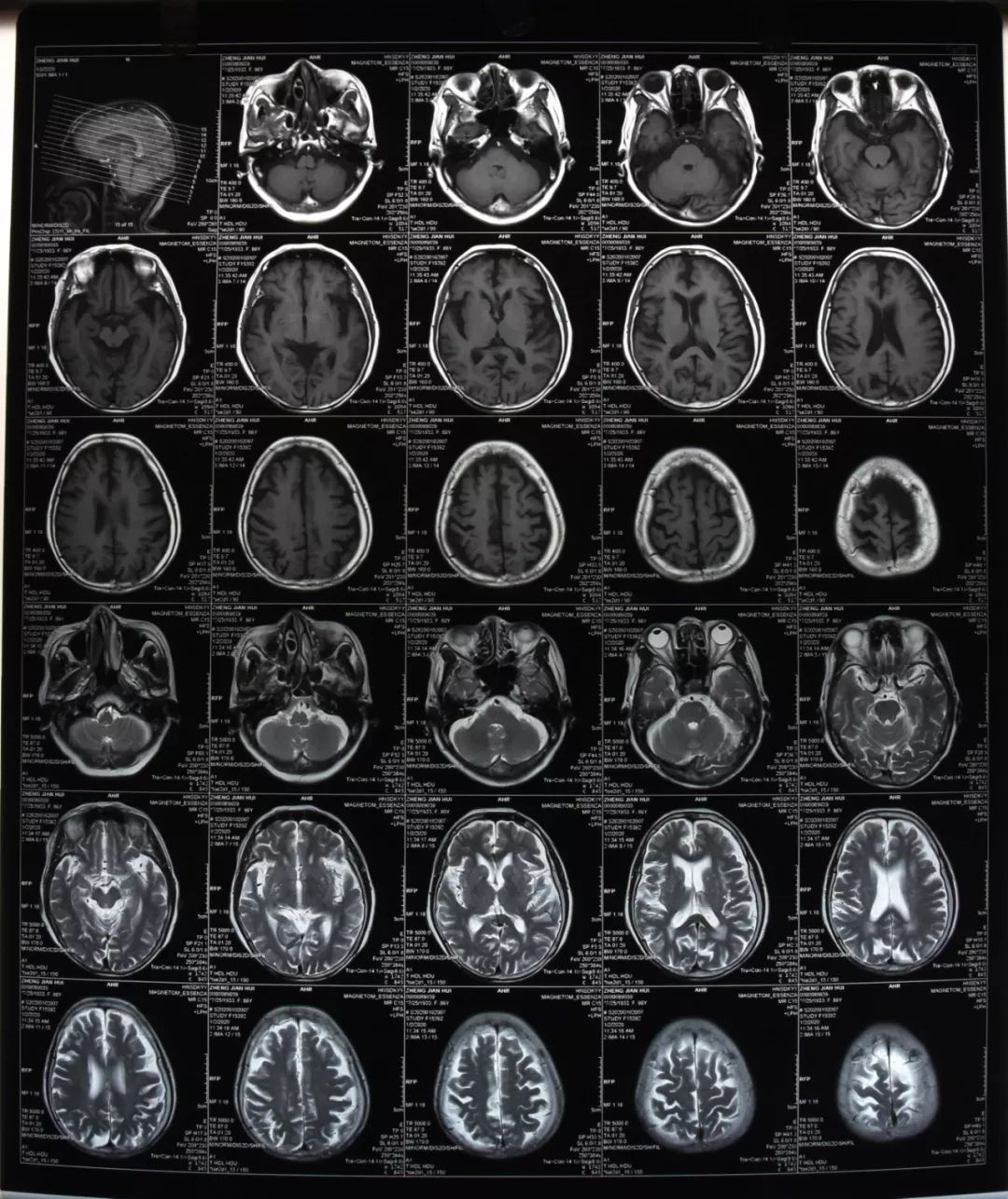 头部mri dwi mra结果回报:1颅脑dwi未见急性梗死灶 2缺血