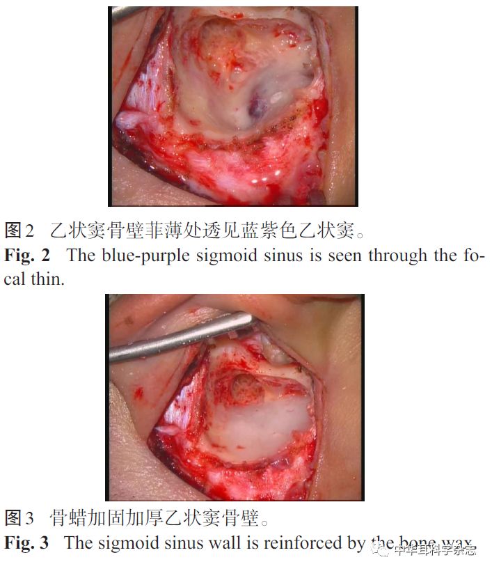 经乳突径路乙状窦骨壁加固术治疗搏动性耳鸣的研究