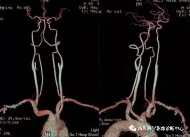 35种头颈部血管cta检查常见变异汇总_动脉