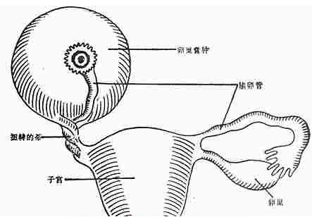 早中孕期卵巢囊肿蒂扭转表现不典型者可先卧床休息