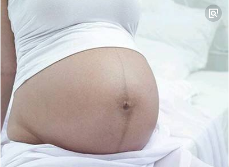 怀孕后，肚子上为何会出现一条黑线？能用这条黑线来预测性别吗？|