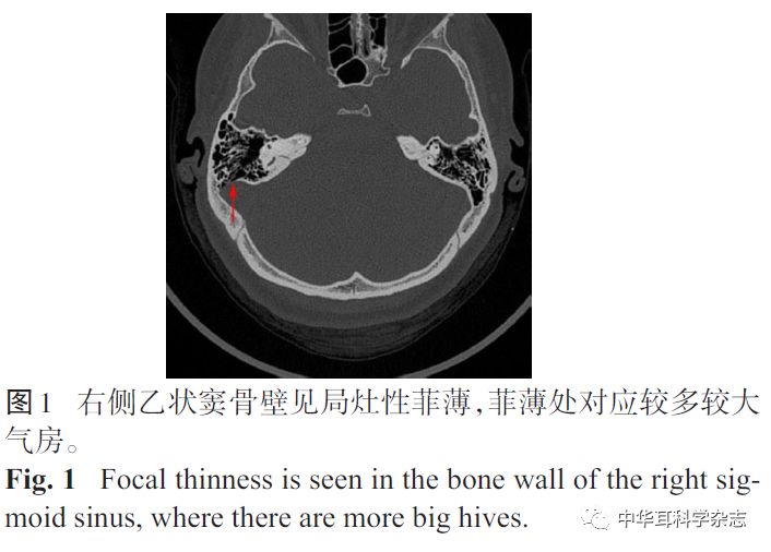 经乳突径路乙状窦骨壁加固术治疗搏动性耳鸣的研究