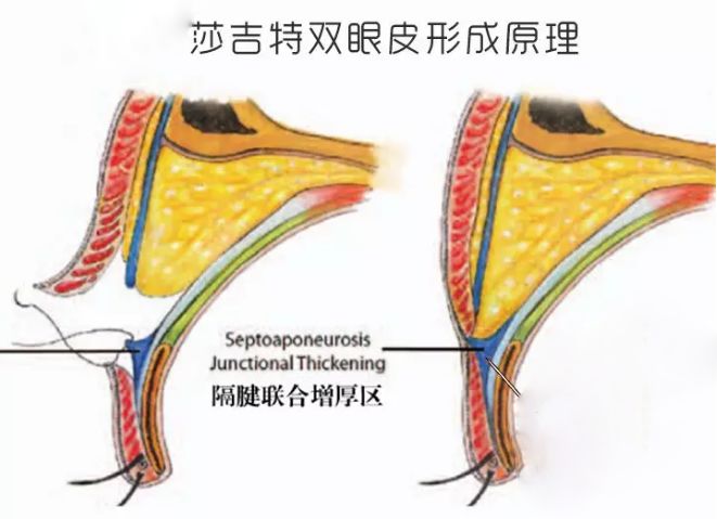 双眼皮一个宽一个窄怎么办