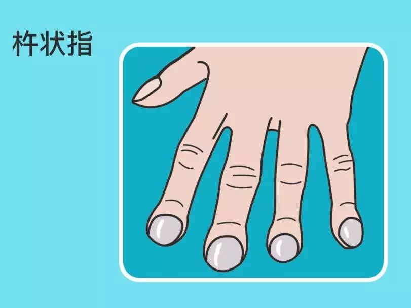 杵状指