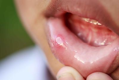 口腔溃疡反复发作，8种方式可帮助缓解，不只补充维生素那么简单 