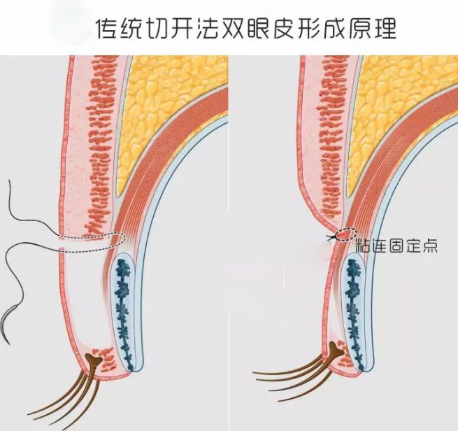 双眼皮一宽一窄怎么办