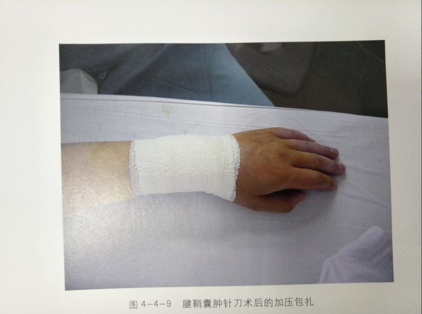 图文详解丨腕背部腱鞘囊肿的针刺治疗