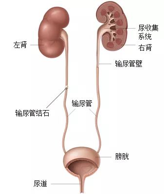 输卵管有结石怎么办