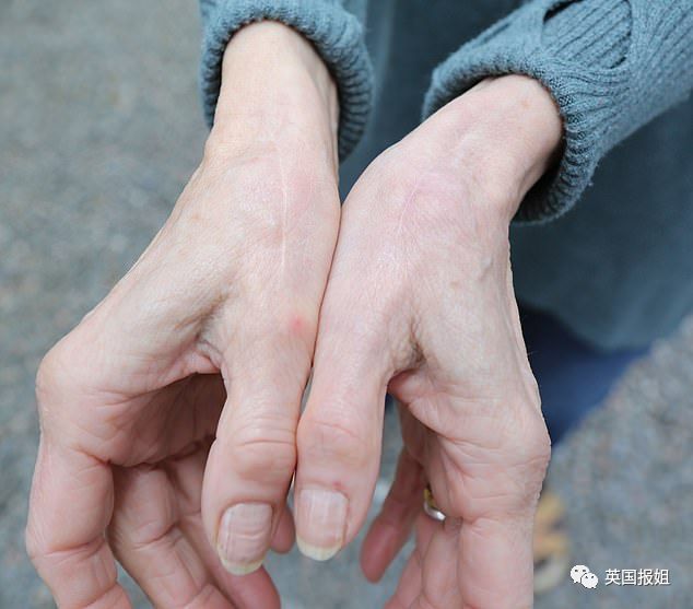 英国报姐：生孩子不疼，亲妈去世不哭，居然有人天生感觉不到痛苦？