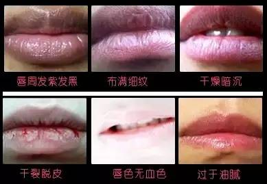 唇腭裂人口_唇腭裂图片(3)