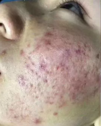 几个月出现一次血便 f1c9f5ccfd1d4c4eab59281a964088ad.png