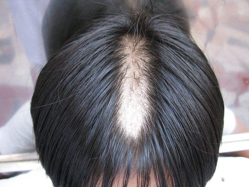 什么是特应性皮炎发病原因 6f4f89340bac49d9a045da6642413936.jpeg